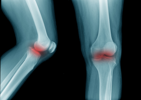 Ligament Tears